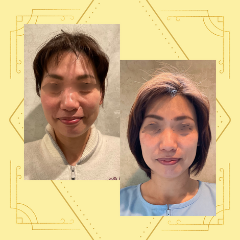 美容鍼　今井さん2